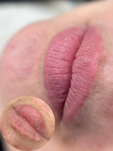 Voor en genezen resultaat na 1 behandeling