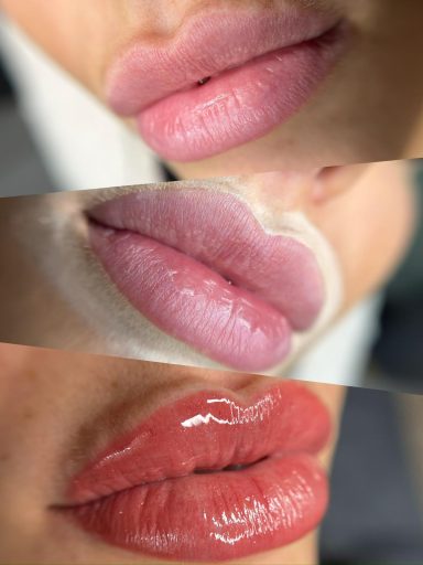 voor - tijdens - direct na de behandeling